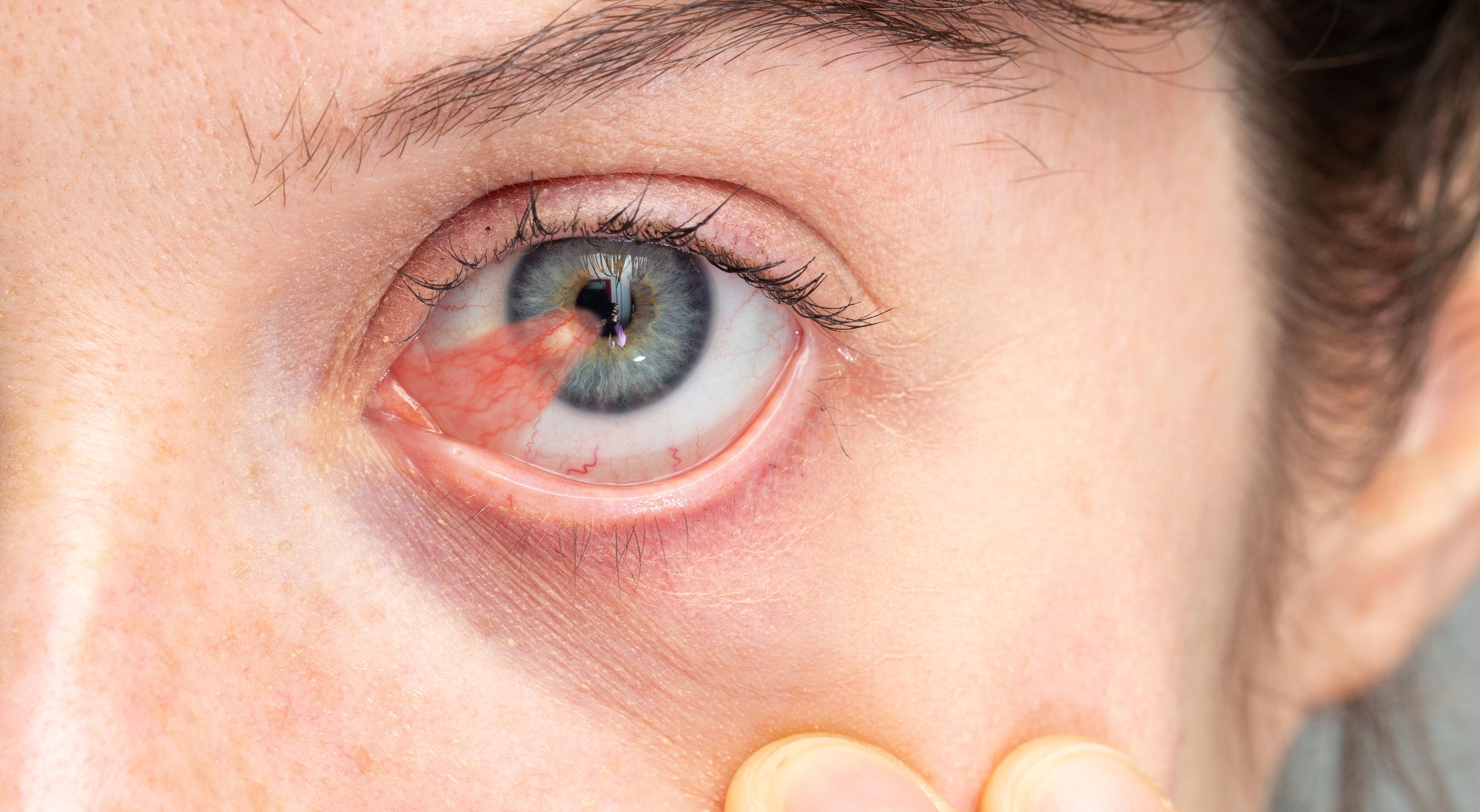 Next Level Retina | Glaucoma, Retina Detachment and Emergency Eye Care