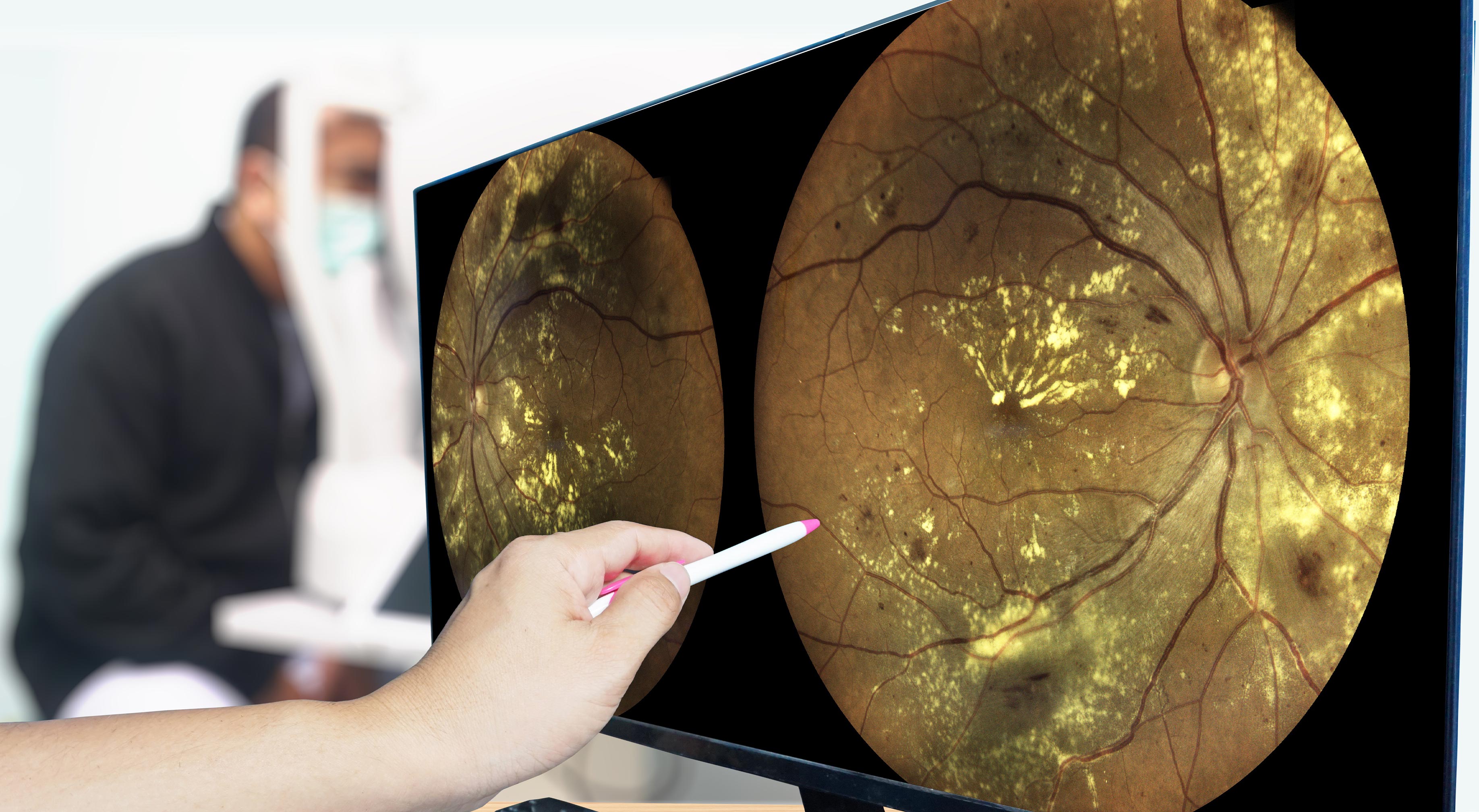 Next Level Retina | Retinal Vein Occlusion, Diabetic Eye Care and Eye Injections